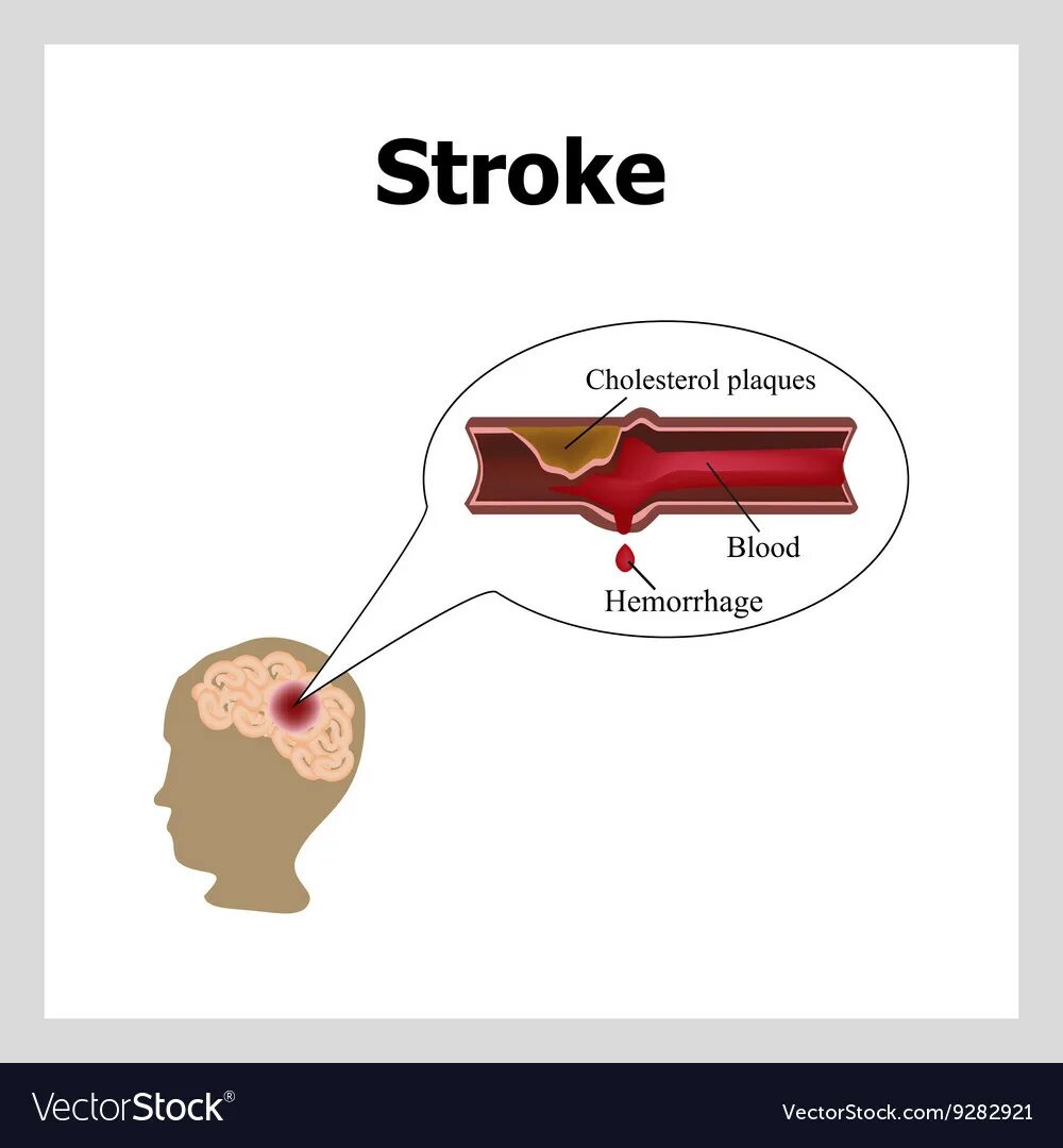 Инсульт холестерин. Cholesterol Plaque gif.