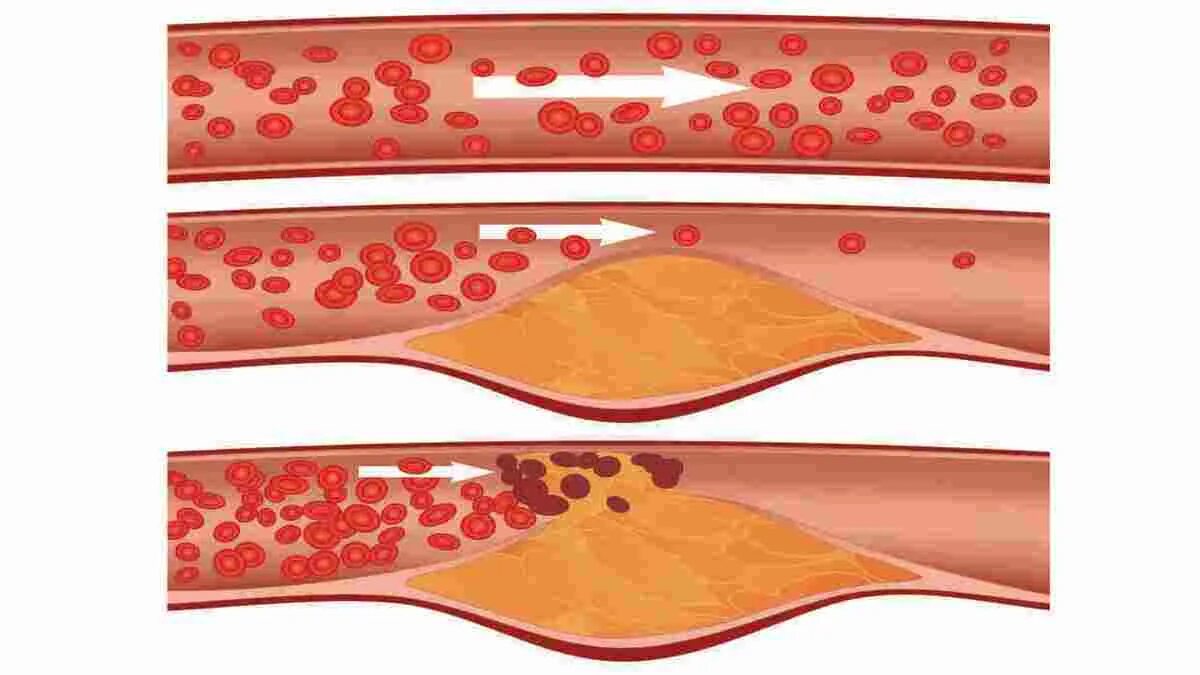 Атеросклерозная бляшка. Атеросклероз и образование атеросклеротических бляшек. Тромб и бляшка разница