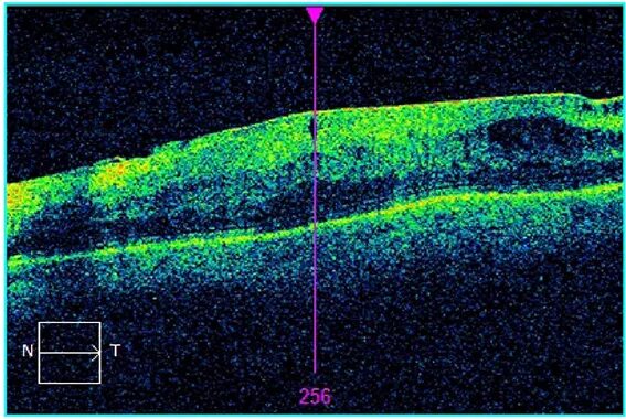 Эпиретинальный фиброз глаза. Эпиретинальная мембрана сетчатки. Эпиретинальный фиброз. Эпиретинальная мембрана на окт. Эпиретинальный фиброз окт.