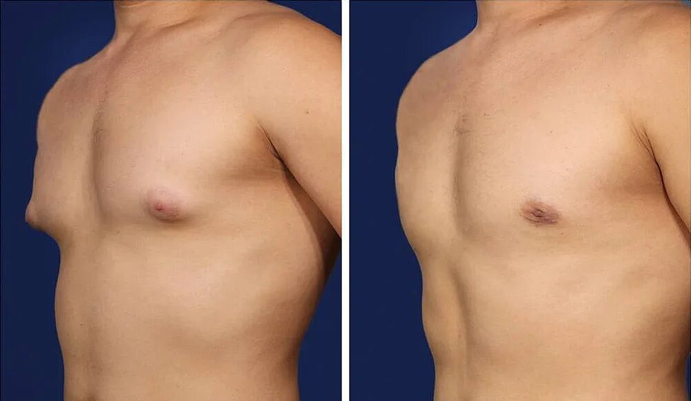 мужская грудь. сосок молочных желез. нормальная мужская грудь. сосок молочных желез. сосок молочных желез.