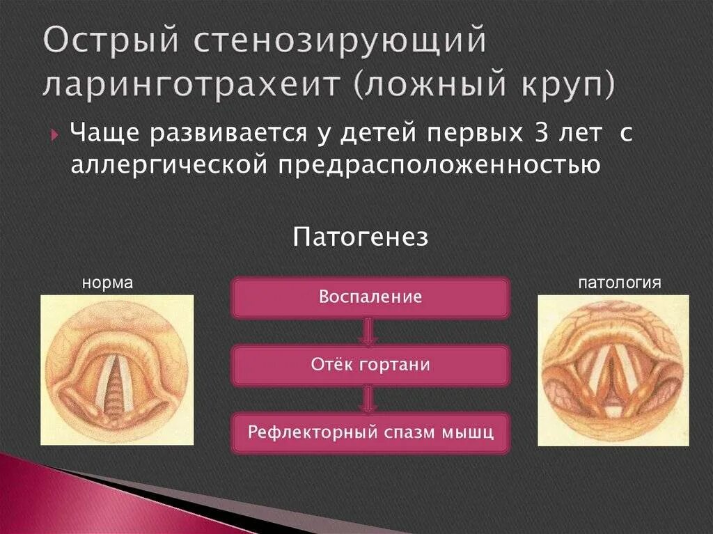 Что такое круп у детей. Ларинготрахеит симптомы 1 степени. гранулезный ларинготрахеит. стенозирующий ларинготрахеит круп. подскладочный ларингит (ложный круп) этиология.