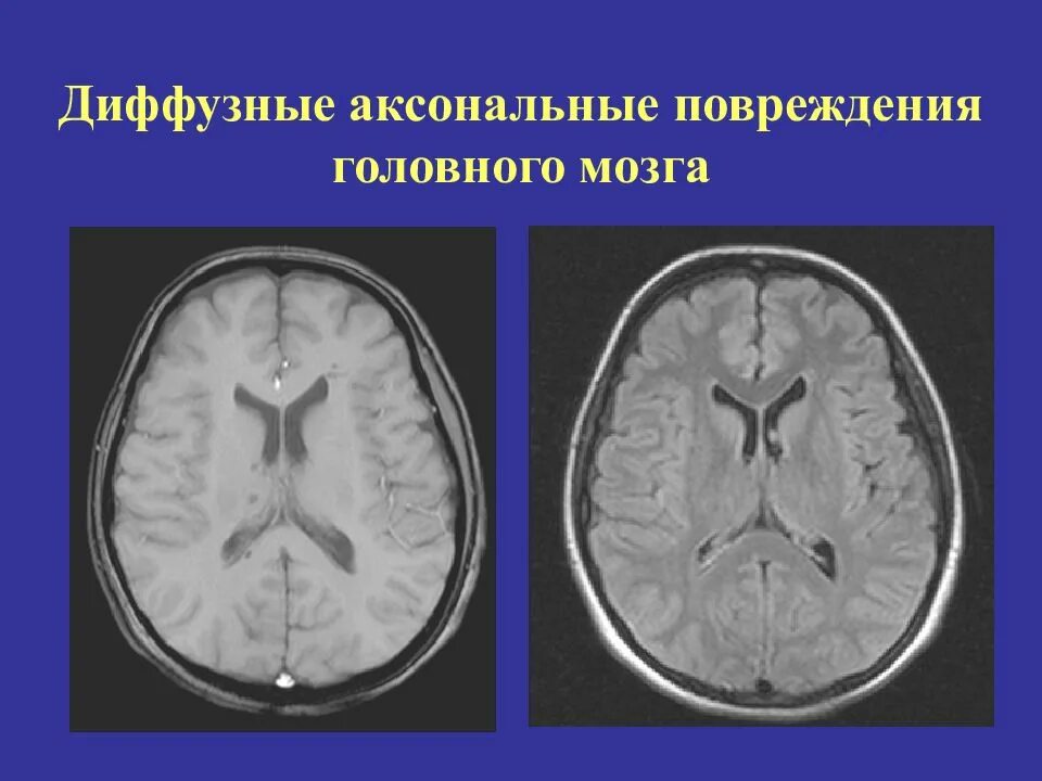 Аксональные повреждения головного мозга. Диффузное аксональное повреждение мозга. Диффузные аксональные повреждения головного мозга мрт. Диффузное аксональное повреждение кт. Диффузная травма мозга