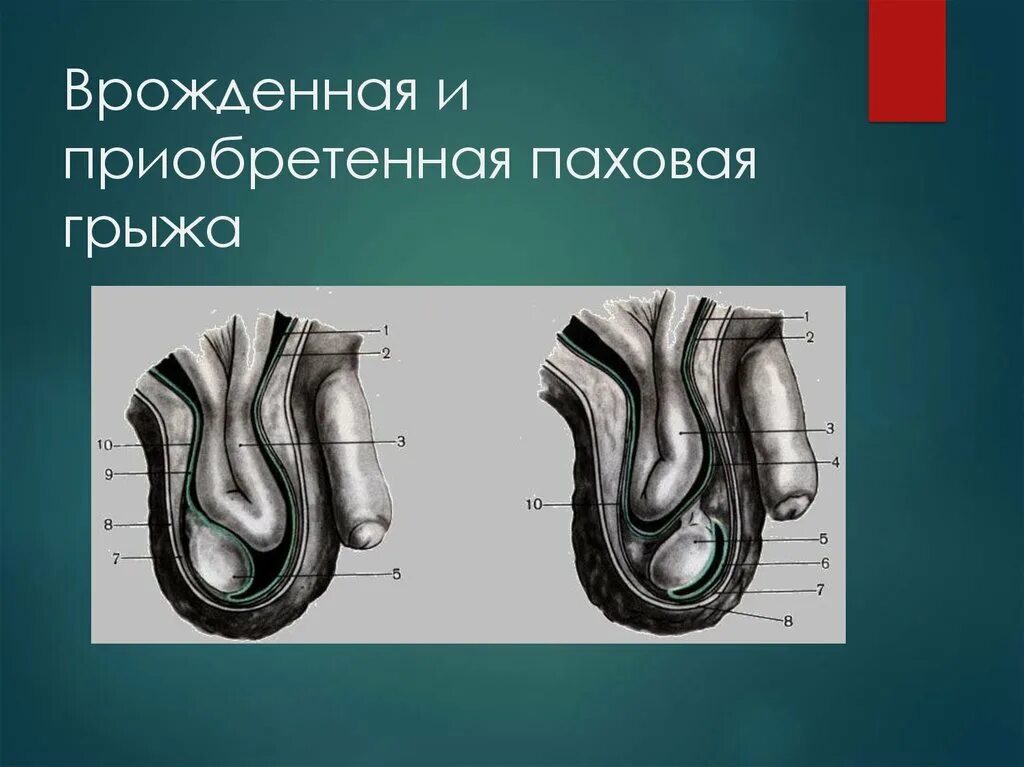 Врожденная и приобретенная косая паховая грыжа. Паховая мошоночная грыжа. Косая приобретенная паховая грыжа. Врожденная паховая грыжа и приобретенная паховая грыжа. Паховая грыжа методы лечения