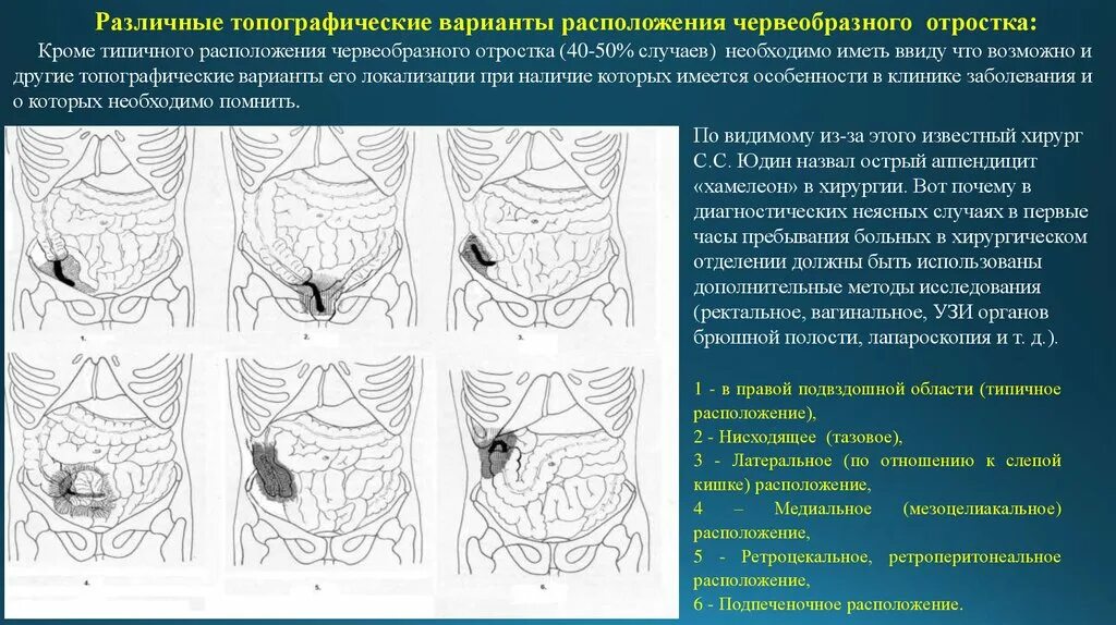 Атипичные расположения червеобразного отростка. Варианты расположение аппендикса в брюшной полости. Аппендицит топография. Ретроцекальная аппендэктомия. Локализация острого аппендицита