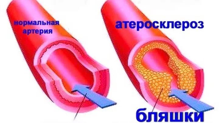 От бляшек и тромбов как очистить