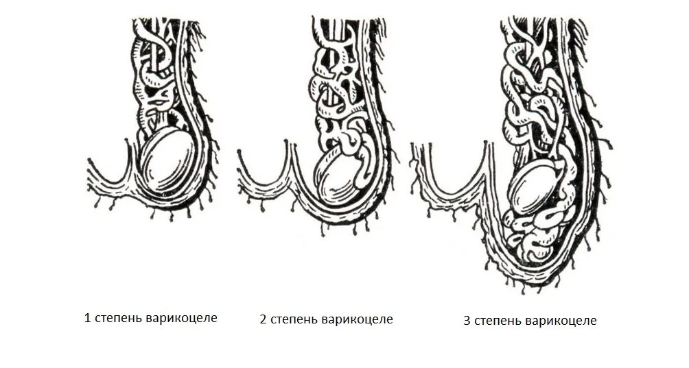 Варикоцеле классификация. Расширение вены семенного канатика