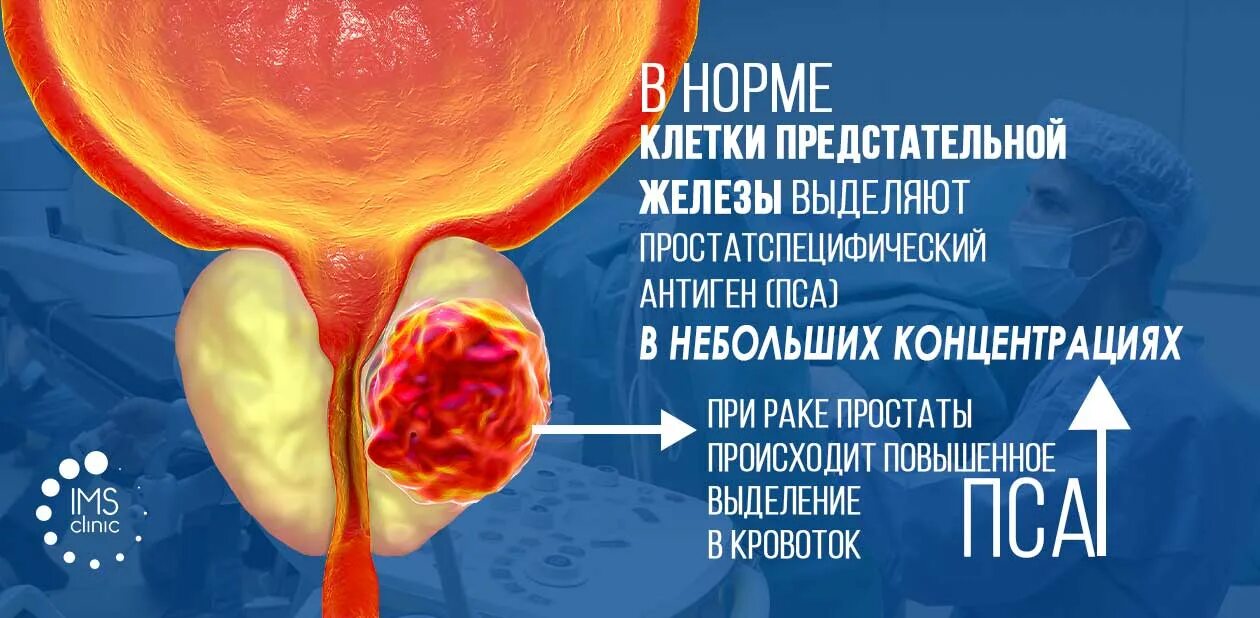 Биопсия предстательной железы. Фьюжн биопсия простаты. Fusion биопсия предстательной железы.