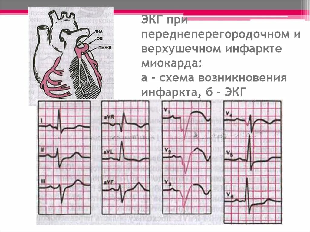 Переднеперегородочный инфаркт на ЭКГ. Острый передне перегородочный инфаркт ЭКГ. Переднеперегородочный инфаркт миокарда на ЭКГ. ЭКГ при передне-перегородочном инфаркте миокарда. Неспецифические изменения нижней стенки