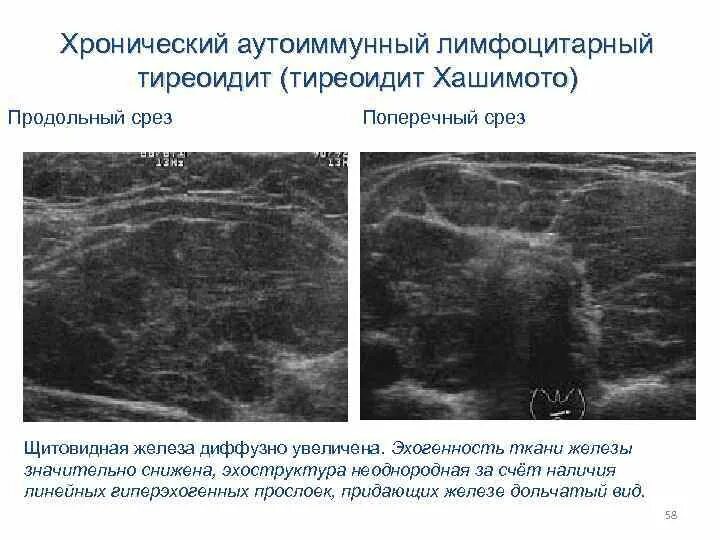 Однородная структура поджелудочной железы. Неоднородная поджелудочная железа узи. Структура железы неоднородная что значит. Положение пациента при узи щитовидной железы. Неоднородная паренхима печени узи.