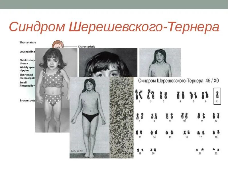 Синдром тернера-шершевского (хо). Генетика шерешевского тернера. Синдром шерешевского тернера кариотип. 1 х хромосома у женщин. 1 х хромосома у женщин.