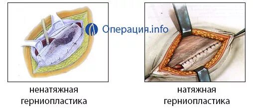 Пластика по бассини при паховой. Операция лихтенштейна при паховой грыже схема. Операция грыжесечения при косой паховой грыже. Грыжесечение по жирару-спасокукоцкому со швами кимбаровского. Паховая грыжа герниопластика.