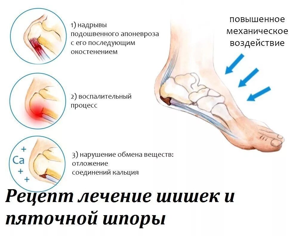 Болит при ходьбе сбоку пятки. Болит пятка пяточная шпора. Тендиноз подошвенного апоневроза стоп. Подошвенный (плантарный) фасциит клиника.