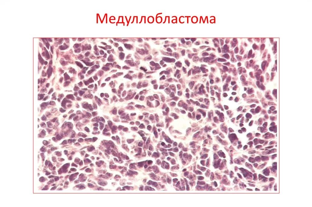 Медуллобластома это. Медуллобластома патологическая анатомия. медуллобластома патанатомия макропрепарат. медуллобластома гистология. медуллобластома мозжечка гистология.
