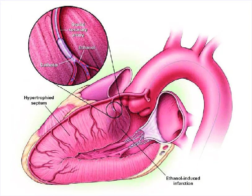 Спиртовая абляция межжелудочковой перегородки. Алкогольная септальная абляция. Спиртовая септальная абляция. Миоэктомия