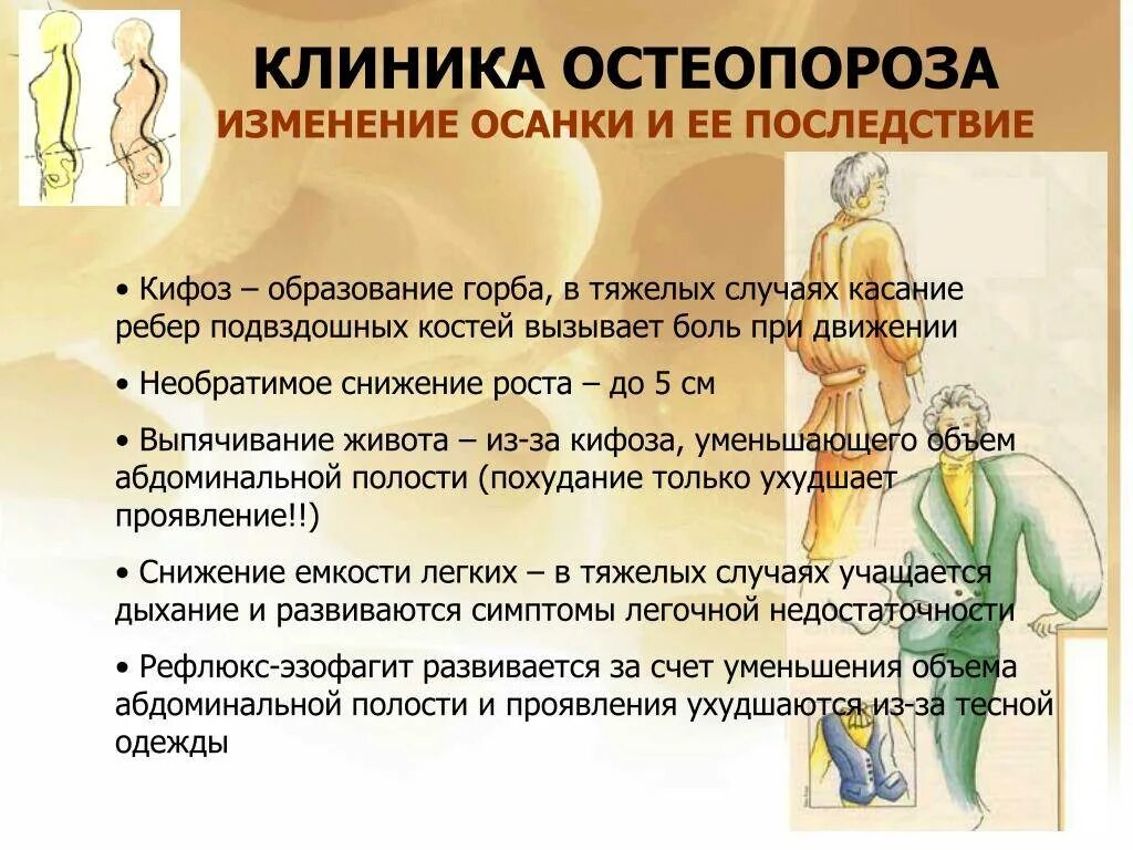 Болезнь остеопороз как лечить. Остеопороз симптомы. остеопороз клиника. клинические проявления остеопороза. основные клинические проявления остеопороза.