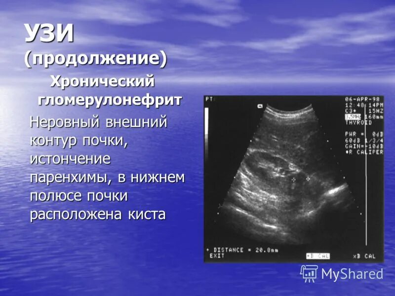 Хронический гломерулонефрит узи. Узи почек при гломерулонефрите. Гломерулонефрит на узи почек. Узи почек при хроническом гломерулонефрите. Узи почек при гломерулонефрите.
