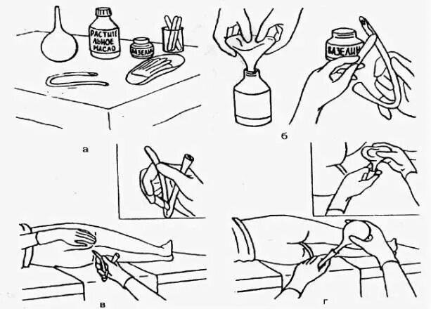 Постановка клизмы алгоритм с картинками. Позы для постановки клизмы. Тренажер для клизмы. Постановка микроклизмы пошагово.
