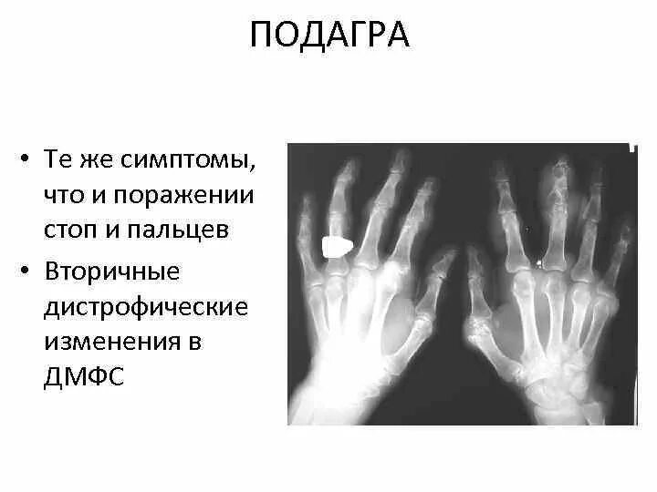 Подагра симптомы у женщин на руках признаки