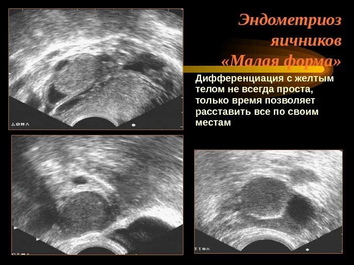 Эндометриомы яичников. Очаги эндометриоза в брюшной полости. Эндометриоз видно на узи