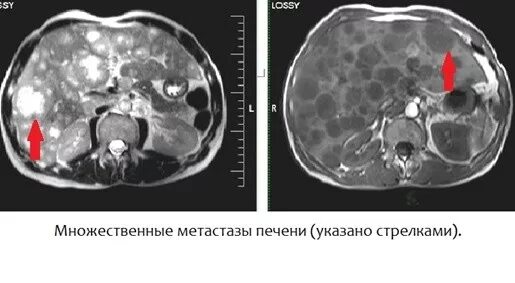 Как отличить метастазы. Метастазы в печени снимки кт. кт брюшной полости метастазы.