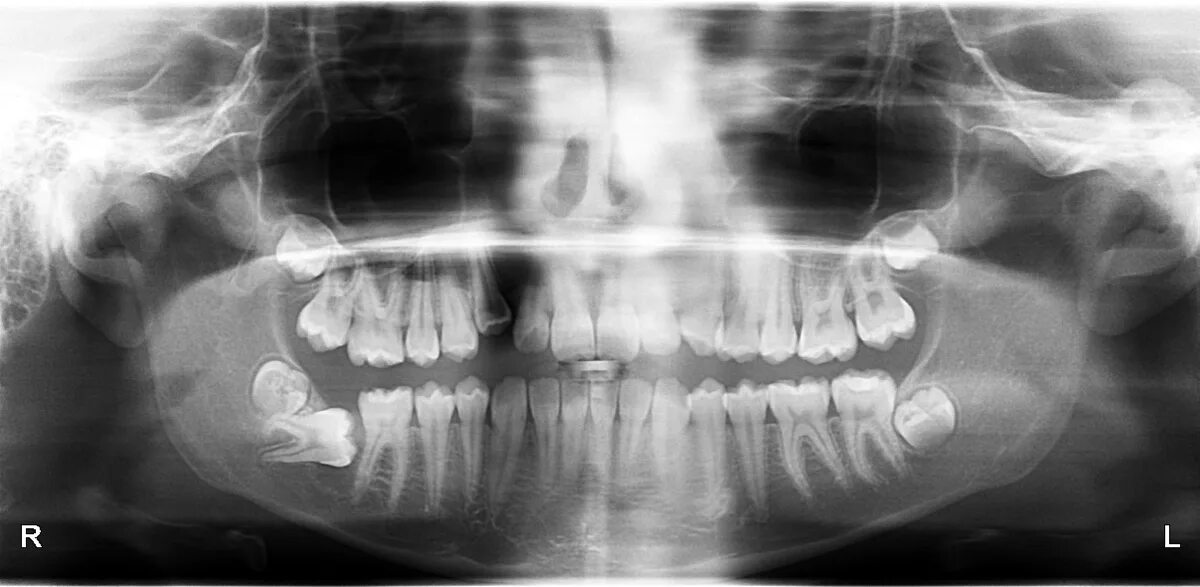 Зуб 8 нижний. Ретенированные зубы мудрости. Ретинированный зуб мудрости. Ретинированный зуб мудрости рентген. Ретинированный клык ОПТГ.