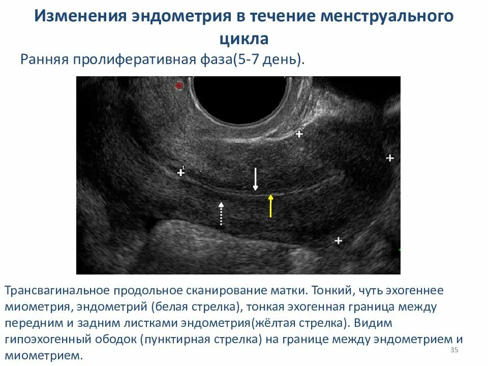 Перед месячными какая эндометрия должна быть. Толщина эндометрия на УЗИ норма. Эндометрия пролиферативная фаза УЗИ. Эндометрий на УЗИ норма. Эндометрий 1 фаза менструационного цикла.