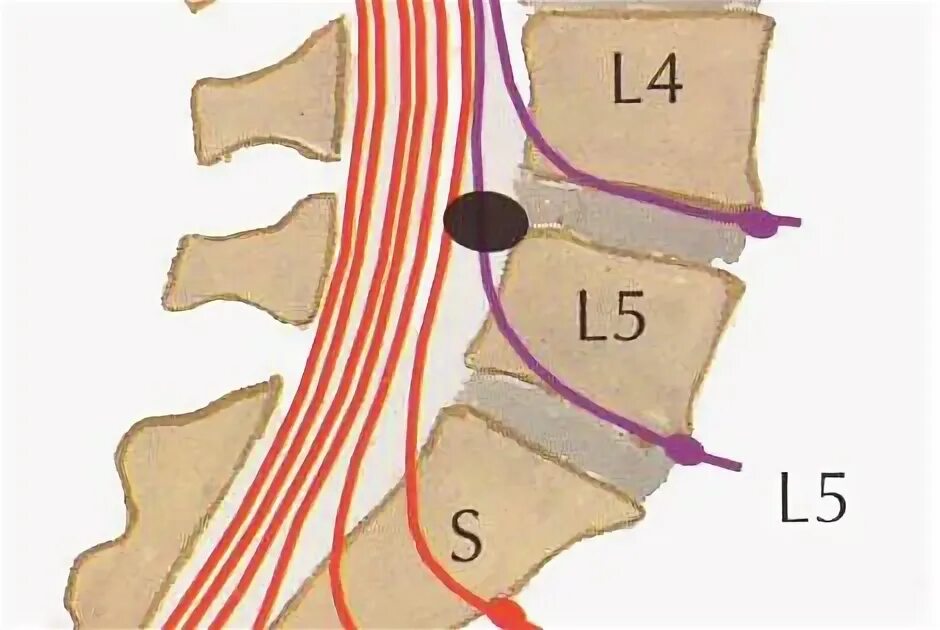 Позвоночник отдел l3 s1. Межпозвонковые диски l2 l3. Протрузия l4 l5 s1 пояснично-крестцового отдела. L5-s1 отдел позвоночника схема. L4 l5 отдел позвоночника протрузия.