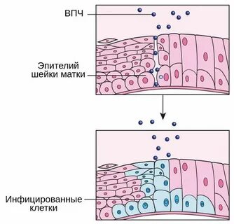 Папилломавирусная инфекция шейки