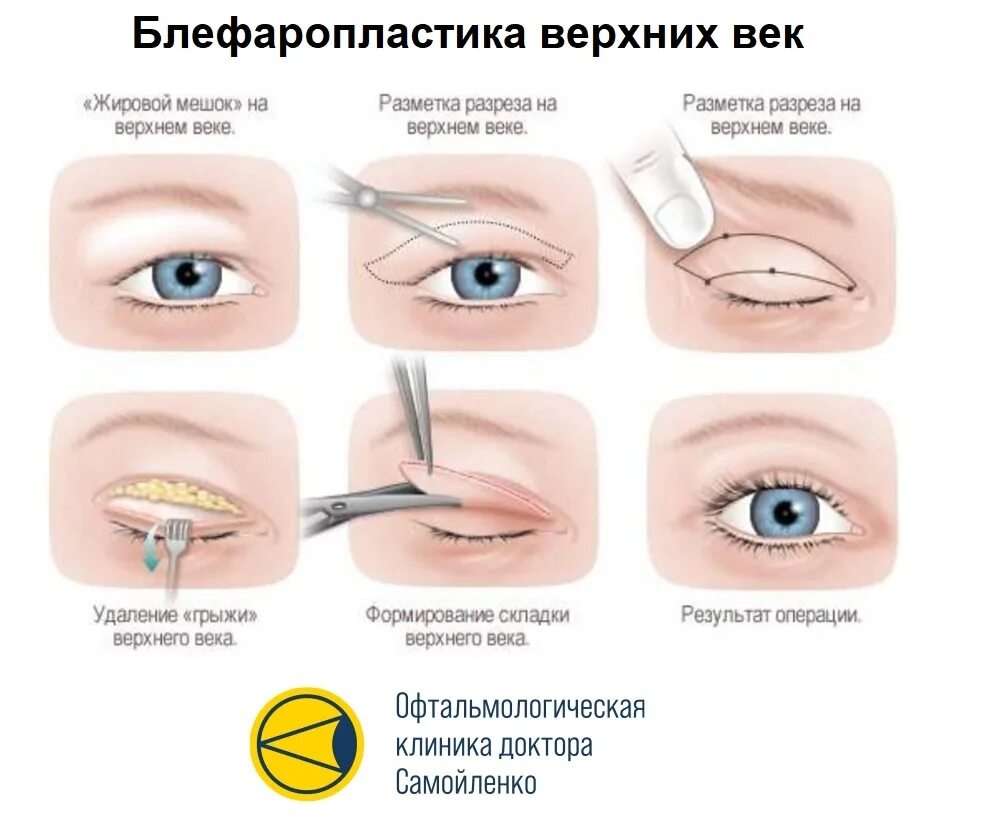 Можно ли поднимать веко. Блефаропластика верхних век схема. Трансконъюнктивальная блефаропластика нижних век. Блефаропластика верхних век нависшее веко. Блефаропластика нижних век схема операции.