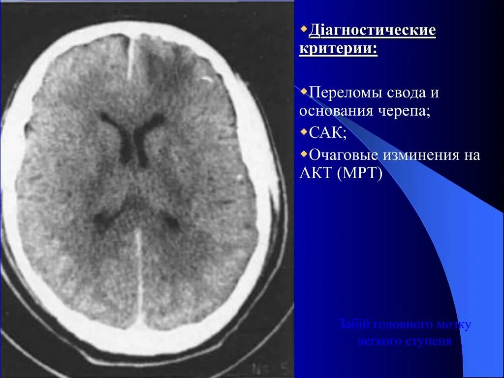 Мрт при сотрясении. Ушиб головного мозга кт степени. Ушиб головного мозга кт мрт. Кт при сотрясении головного мозга.
