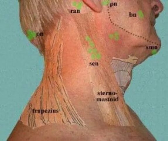 Лимфоузлы и мышцы. Воспаленные надключичные лимфоузлы. Подбородочный лимфоузел. Позадиушные лимфоузлы.