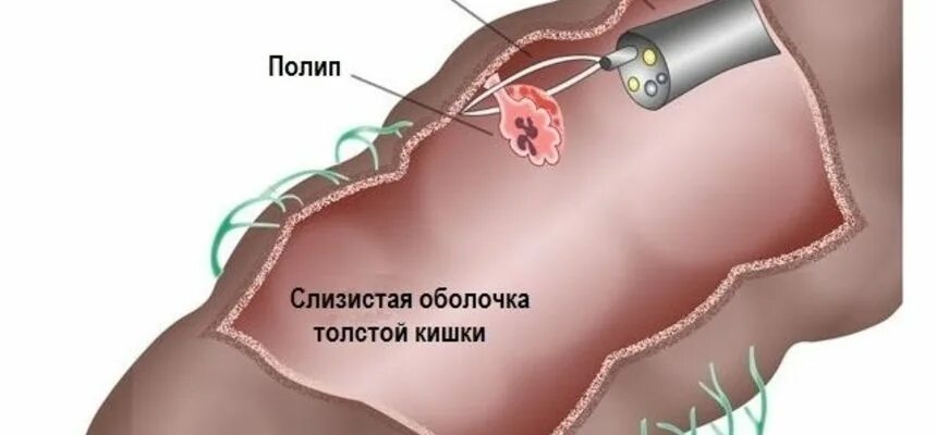 Что делать после удаления полипов кишечника