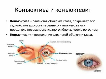 Можно ли коньюктивитом