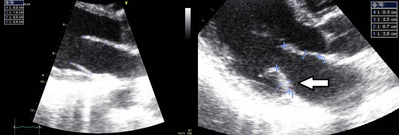 Отрыв хорды митрального клапана на УЗИ. Отрыв хорды митрального клапана ЭХОКГ. Створки митрального клапана на УЗИ. Утолщение створок митрального клапана ЭХОКГ.