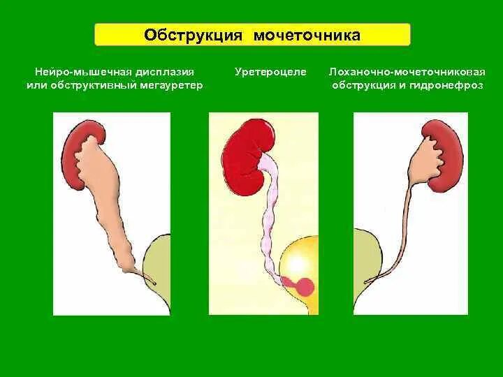 Мочеточники матка. Обструкция нижних мочевыводящих путей. Обструкция мочеточника. Обструкция мочеточника камнем. Непроходимость мочеточника.