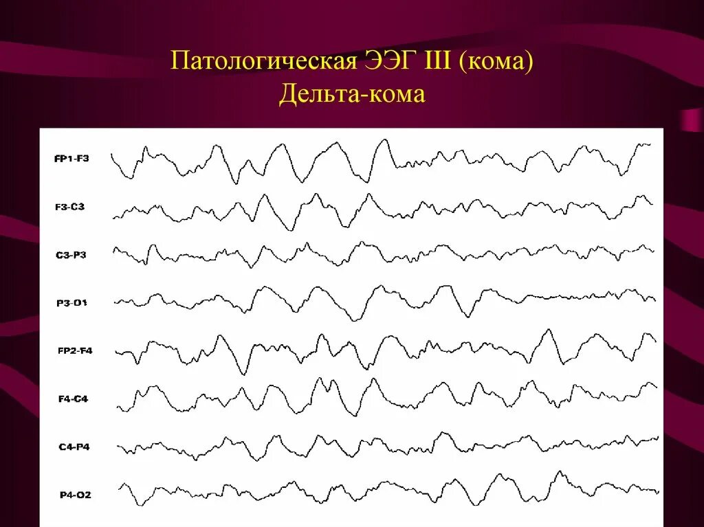 Ээг 9. ЭЭГ волны патологические. Патологические ритмы ЭЭГ. Дельта кома на ЭЭГ. ЭЭГ паттерны патологические.