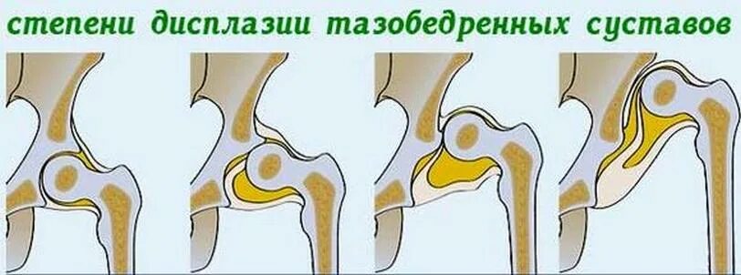 Дисплазия сустава у новорожденного лечение