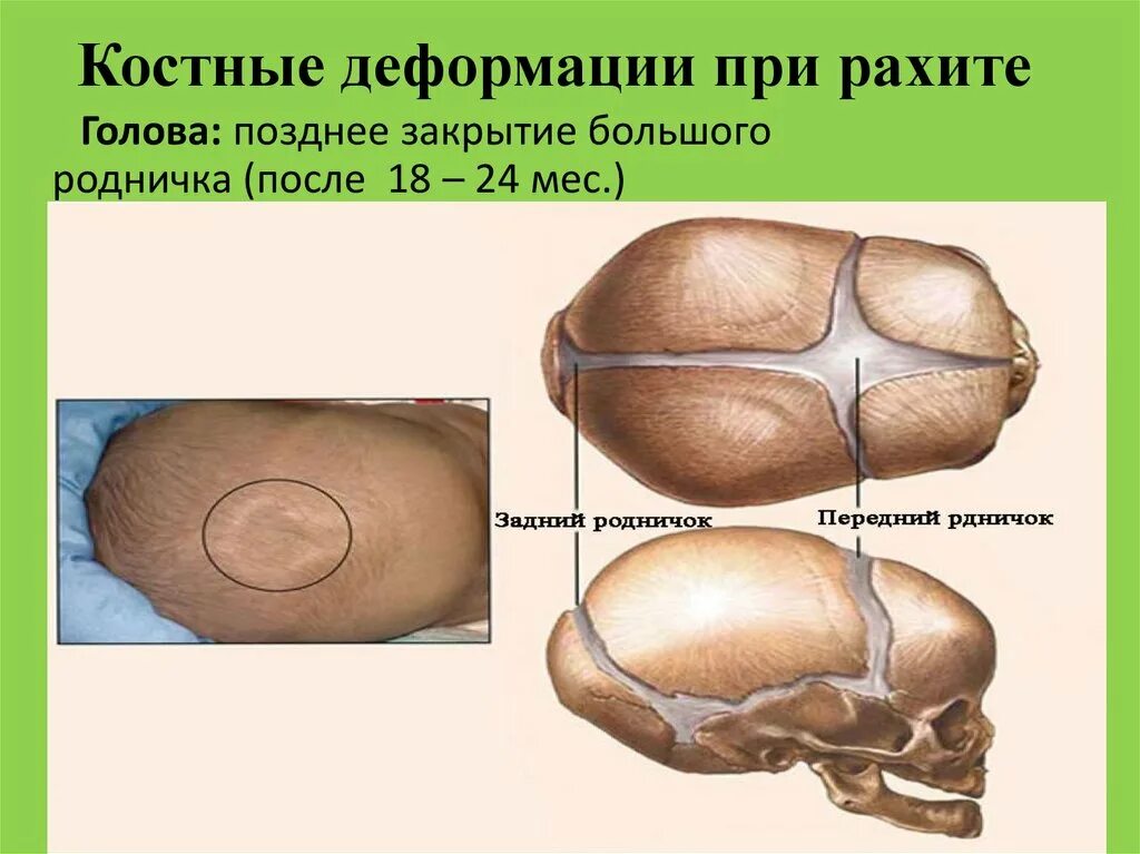 Закрытие родничка у детей. Родничок у новорожденных. Форма малого родничка у новорожденного. Большой Родничок у новорожденного.