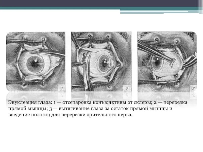 Ост прямая. Энуклеация глазного яблока техника. Эвисцерация глазного яблока. Энуклеация и эвисцерация. Энуклеация глазного яблока у собаки.