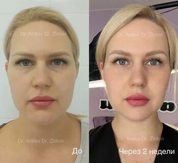 Комок биша что это такое фото