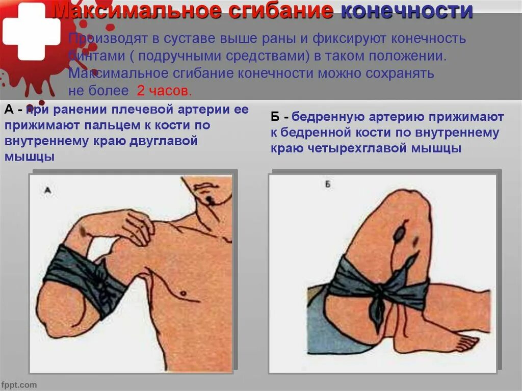 Максимальное сгибание конечности. Максимальное сгибание конечности в суставе. Максимальное сгибание конечности при артериальном кровотечении. Максимальное фиксированное сгибание конечности.