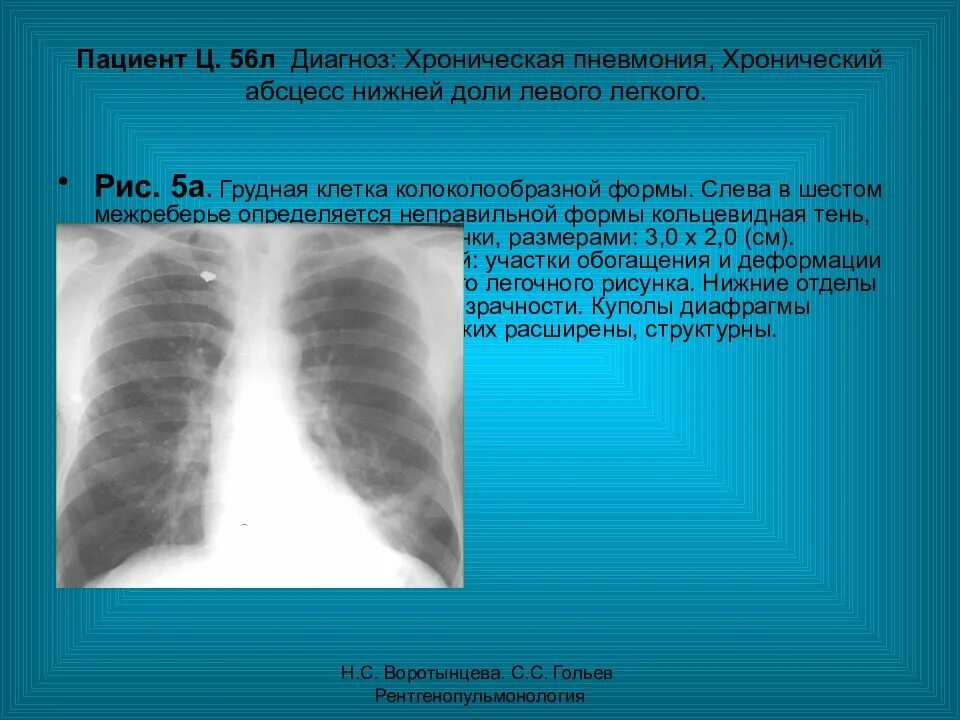 Хобл постановка диагноза. Рентгенологическая диагностика туберкулеза. Как ставится диагноз хобл. Диссеминированный туберкулез кт. Диф диагностика заболеваний легких.