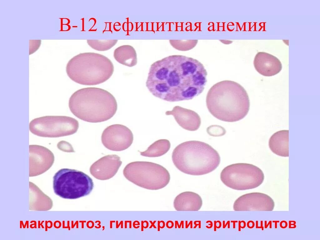 В12 в эритроцитах. Гипохромия и гиперхромия. б 12 дефицитная анемия картина крови. эритроциты при в12 дефицитной. мазок крови при в12 дефицитной анемии.