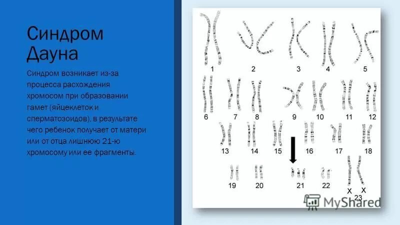 Лишняя 21 хромосома