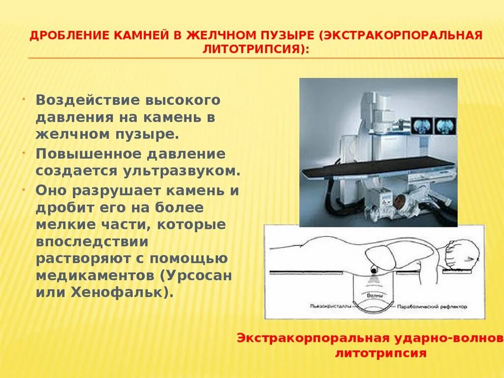 Дробление камней в желчном пузыре ультразвуком. Литотрипсия камней в желчном пузыре. Экстракорпоральная литотрипсия желчного пузыря. Операция дробление камней в желчном пузыре.