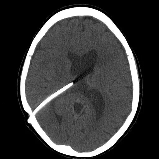 Гидроцефалия шунтирование мозга. Шунтирование желудочков. Вентрикулоперитонеальный шунт на кт. Перитонеальный шунт при гидроцефалии.