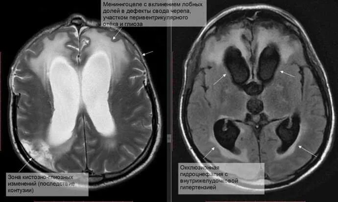 Глиоз мозга последствия. Глиоз в головном мозге на мрт. Кистозно-глиозная трансформация головного мозга на кт. Атрофические изменения головного мозга кт. Кистозно-атрофические изменения головного мозга на кт.