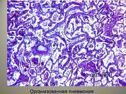 Организующаяся пневмония это