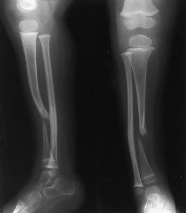 Ложный сустав берцовой кости. Ложный сустав малоберцовой кости рентген. Ложный сустав после перелома берцовой кости. Ложный сустав большеберцовой кости.