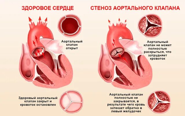 Сколько длится операция по замене клапана. Митральные пороки сердца (стеноз, недостаточность. ревматический митральный стеноз. стеноз митрального клапана. аортальный клапан 3 створчатый.